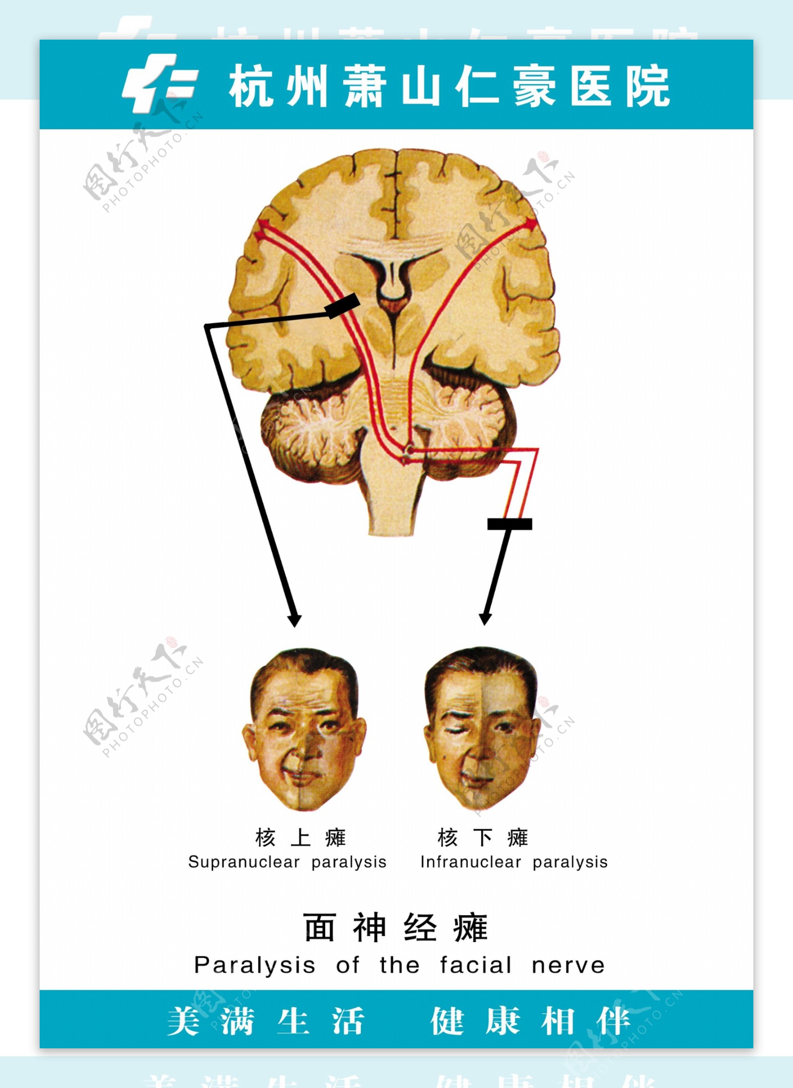 医疗人体科室挂图11面神经瘫