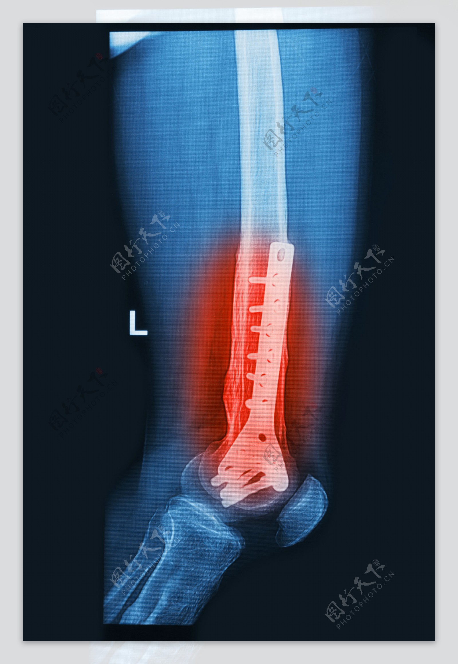 膝关节炎图片