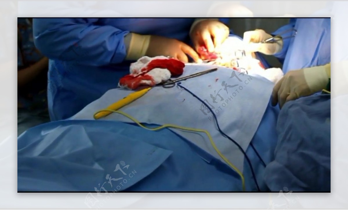 手术中的医生视频素材
