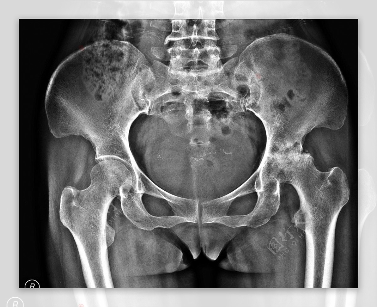 X线骨盆拍片