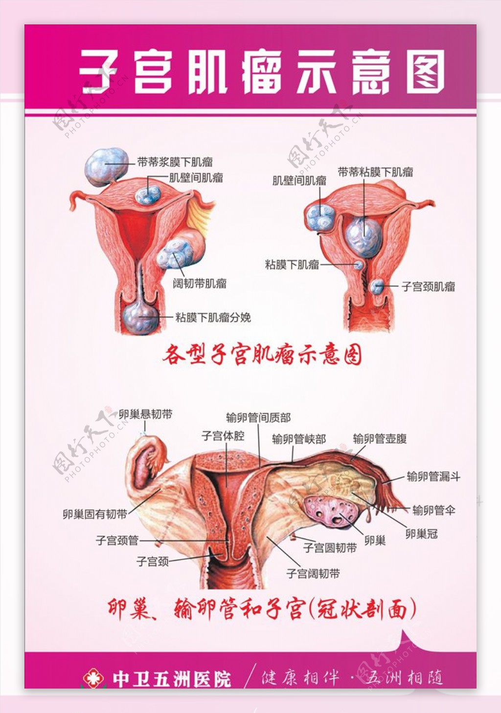 子宫肌瘤